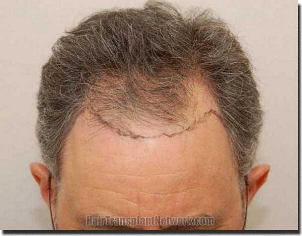 Hair restoration procedure results