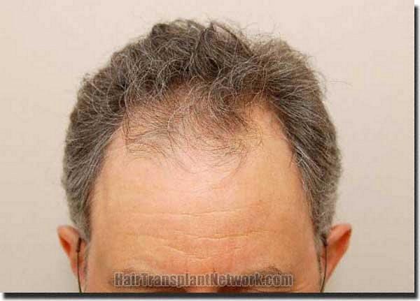 Hair restoration procedure results