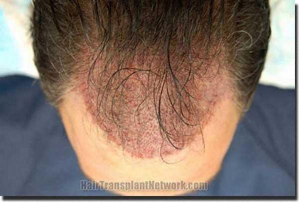 Hair restoration procedure results