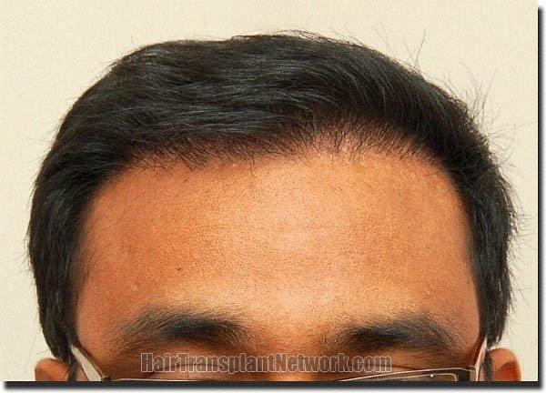 Hair restoration procedure results