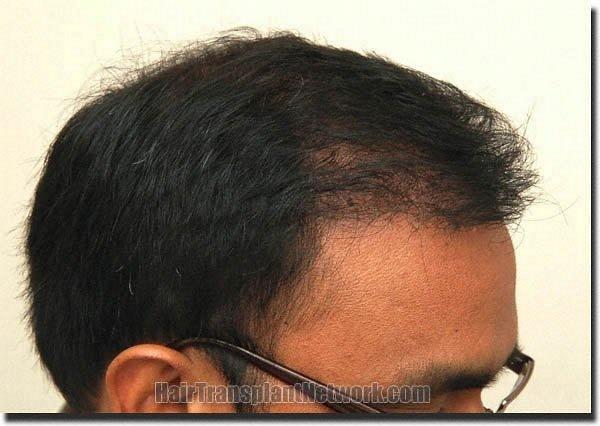 Hair restoration procedure results