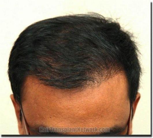 Hair restoration procedure results