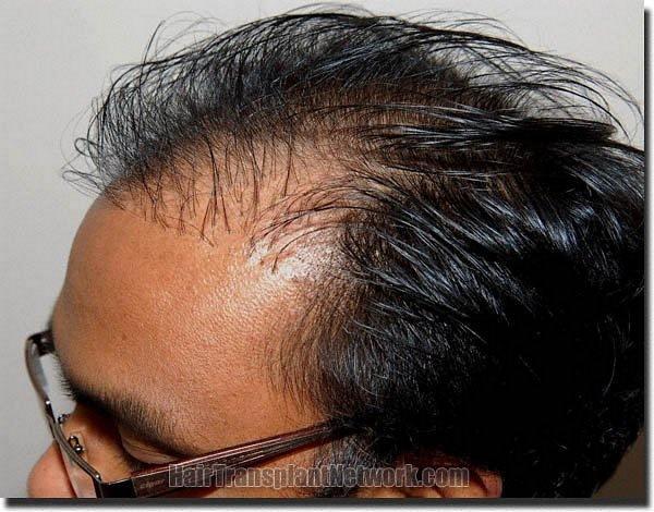 Hair restoration procedure results