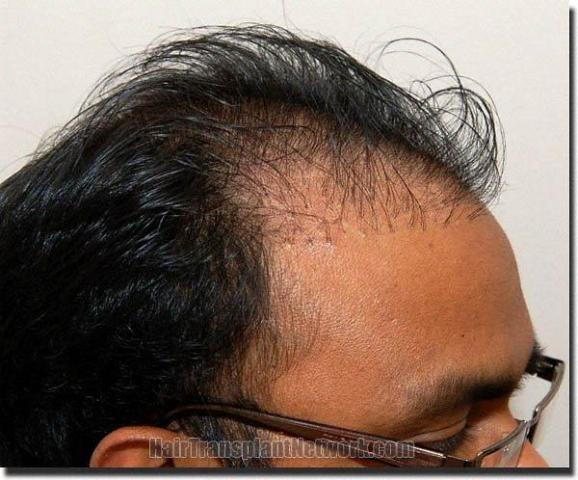 Hair restoration procedure results