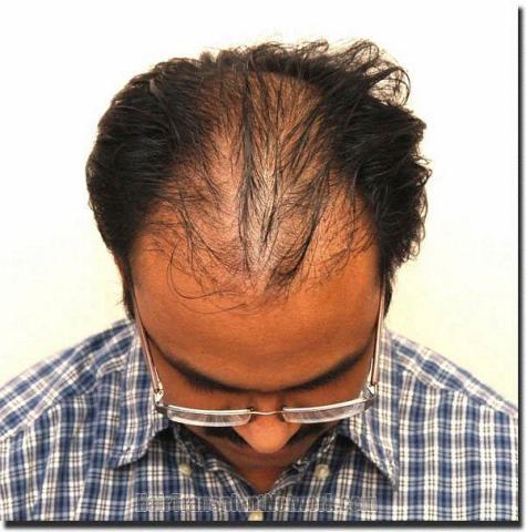 Hair restoration procedure results