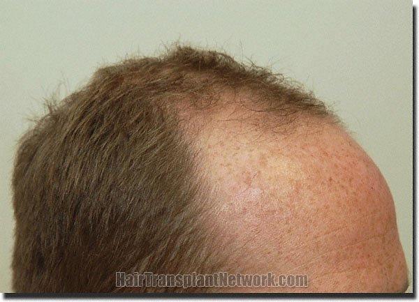 Hair restoration procedure results