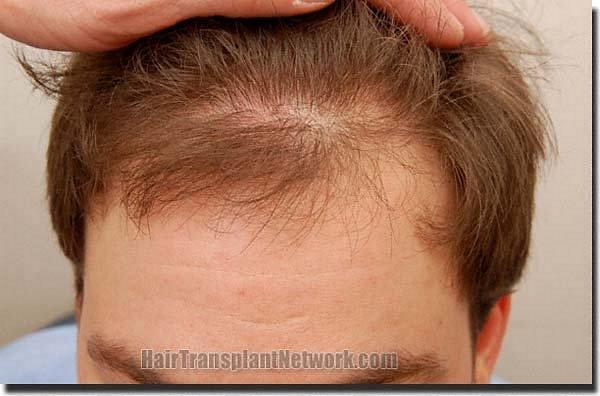 Hair restoration procedure results