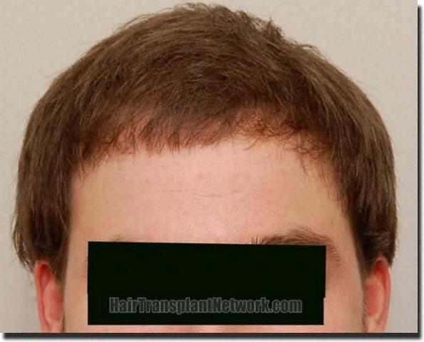 Hair restoration procedure results