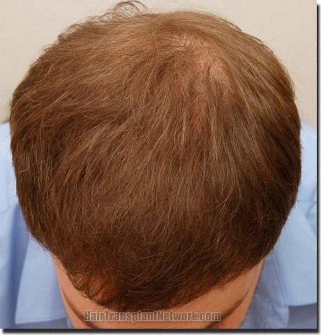 Hair restoration procedure results