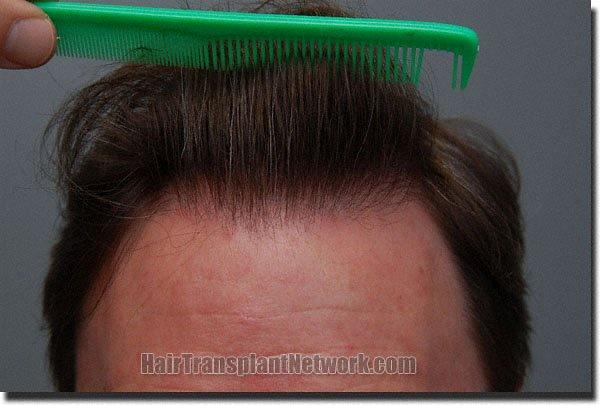 Hair restoration procedure results