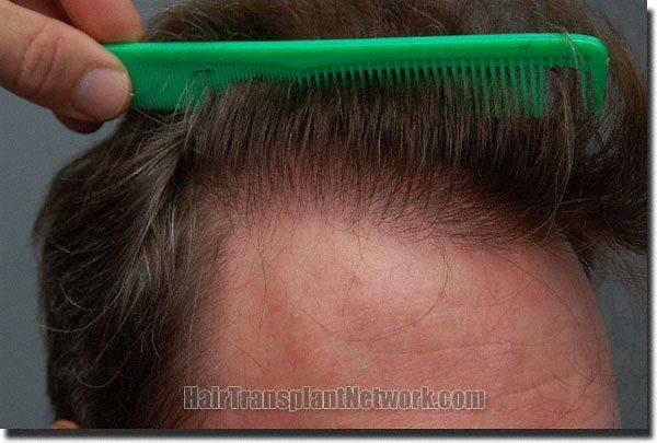 Hair restoration procedure results