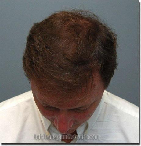 Hair restoration procedure results