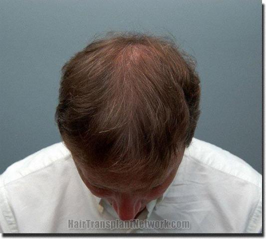 Hair restoration procedure results