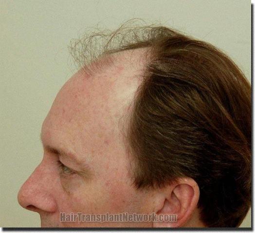 Hair restoration procedure results