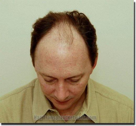 Hair restoration procedure results