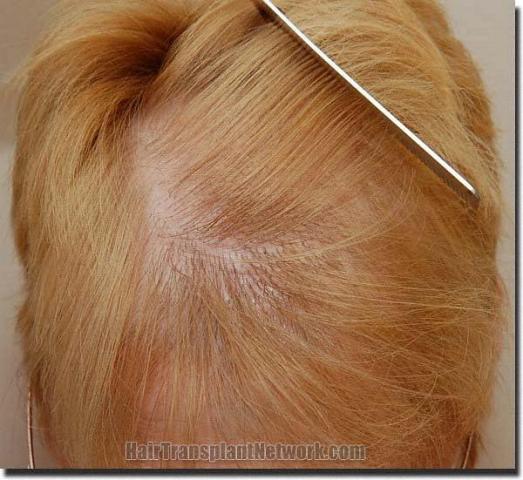 Hair restoration procedure results