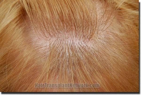 Hair restoration procedure results