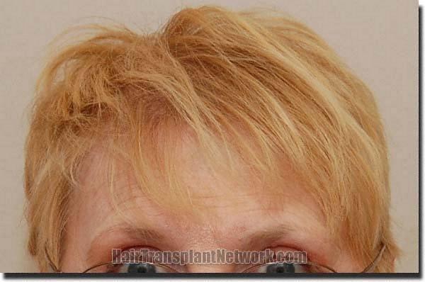 Hair restoration procedure results