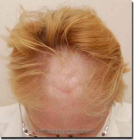 Hair restoration procedure results