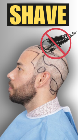 Do You Have To Shave Your Head For A Hair Transplant?