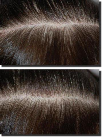 Hair restoration procedure results