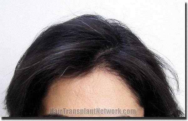 Hair restoration procedure results