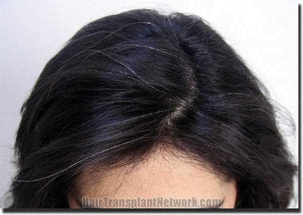 Hair restoration procedure results