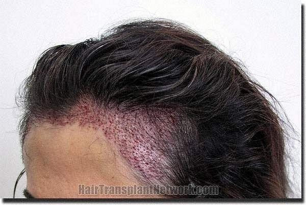 Hair restoration procedure results