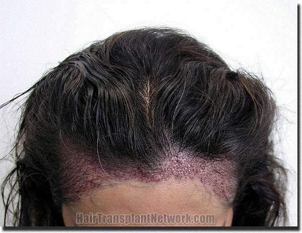 Hair restoration procedure results