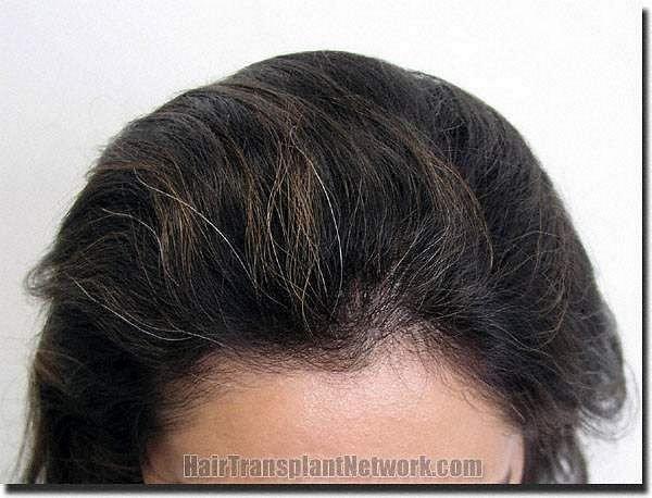 Hair restoration procedure results