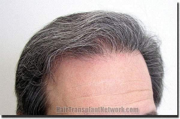 Hair restoration procedure results