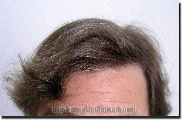 Hair restoration procedure results