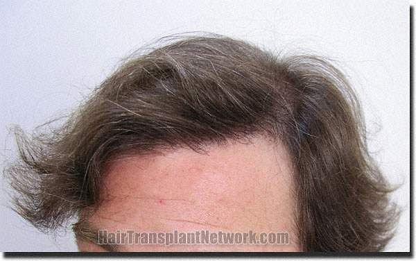 Hair restoration procedure results