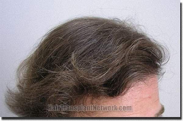 Hair restoration procedure results