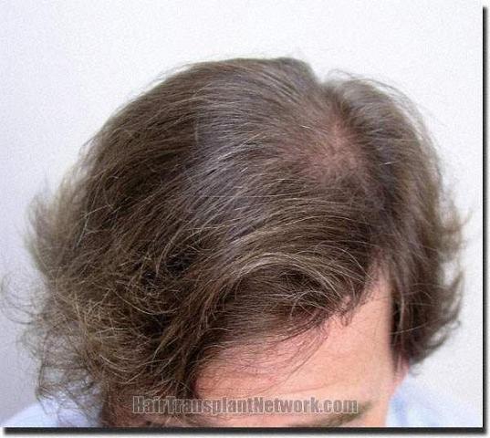 Hair restoration procedure results