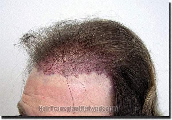 Hair restoration procedure results