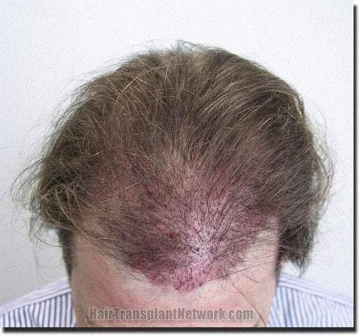 Hair restoration procedure results