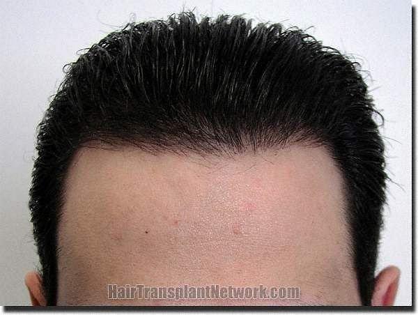 Hair restoration procedure results