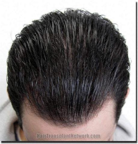 Hair restoration procedure results