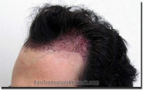 Hair restoration procedure results