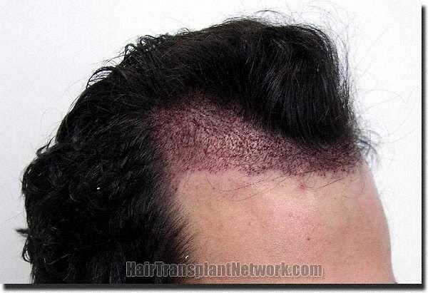 Hair restoration procedure results