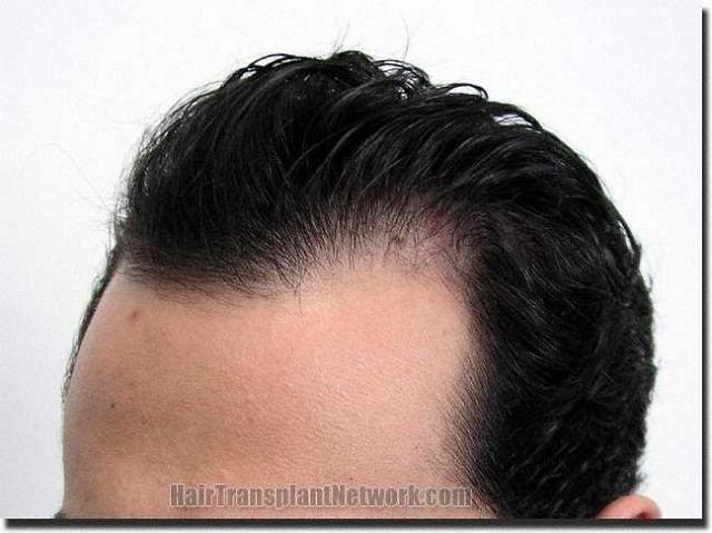 Hair restoration procedure results