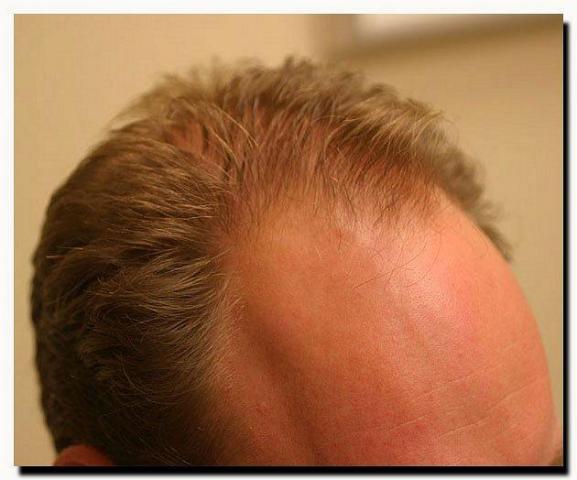 Hair restoration procedure results