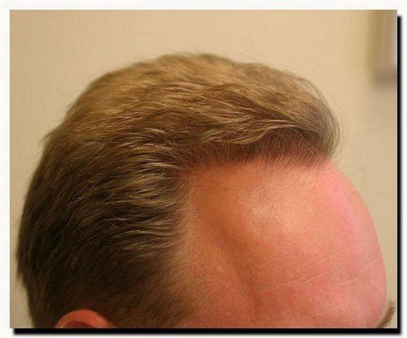 Hair restoration procedure results