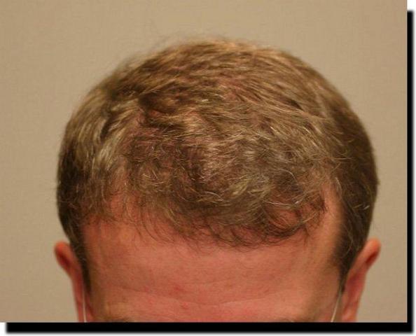 Hair restoration procedure results