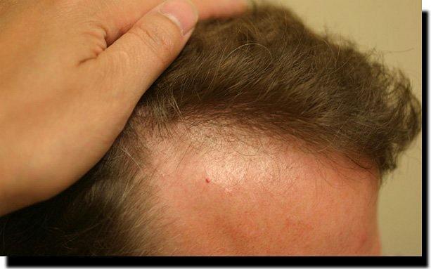 Hair restoration procedure results