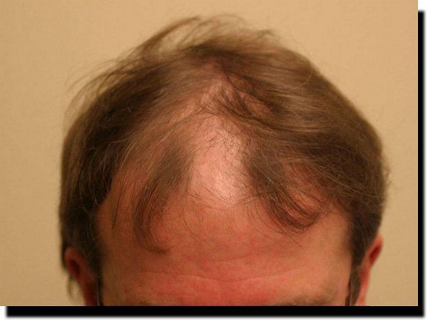 Hair restoration procedure results