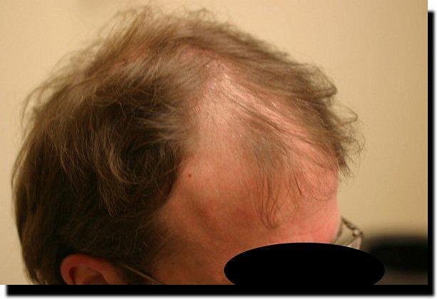 Hair restoration procedure results