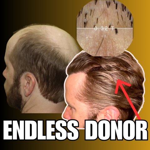 Verteporfin Endless Donor Supply Will Cure Hair Loss