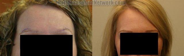 Eyebrow transplant on female patient before and after photos